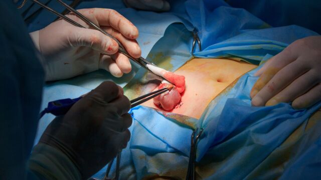 جراحی استومی چیست و برای استوما چه مراقبت هایی لازم است؟ | دکتر یعقوب حاتمی متخصص جراحی عمومی ، لاپاراسکوپی و زیبایی