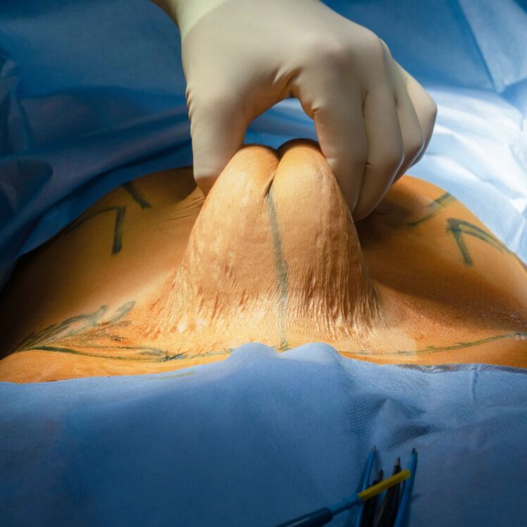 ابدومینوپلاستی یا جراحی زیبایی شکم(پیکرتراشی) | دکتر یعقوب حاتمی متخصص جراحی عمومی ، لاپاراسکوپی و زیبایی